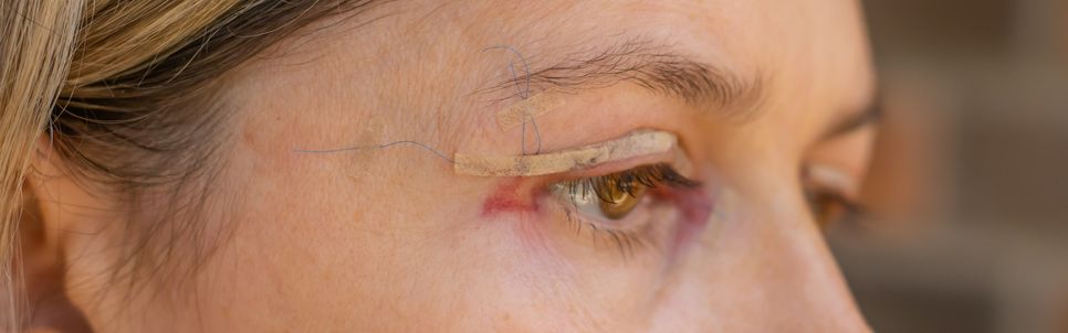 Operace očních víček: Malý zákrok s velkým efektem