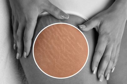 Odstranění strií: Jak se zbavit strií efektivně a bezpečně
