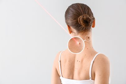 Laserové odstranění kožních výrůstků
