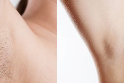 Laserová epilace – účinná metoda odstraňování chloupků