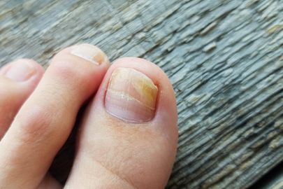 Onychomykóza nebo-li plíseň nehtů: Jak se projevuje a jak jí předejít