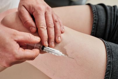 Odstranění metličkových žilek sklerotizací