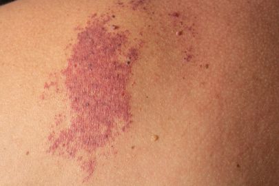 Hemangiomy: Proč se objevují a jsou nebezpečné?