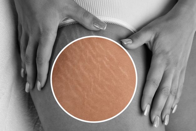 Odstranění strií: Jak se zbavit strií efektivně a bezpečně