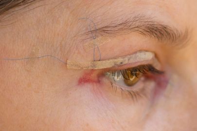 Pokleslá oční víčka vás již trápit nemusí: Řešení existuje