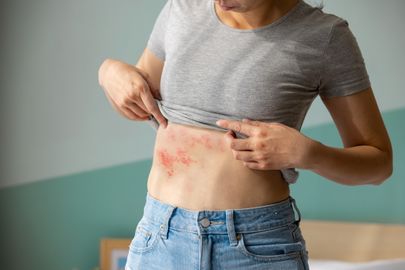 Vyrážky: Průvodce symptomy, druhy a prevencí