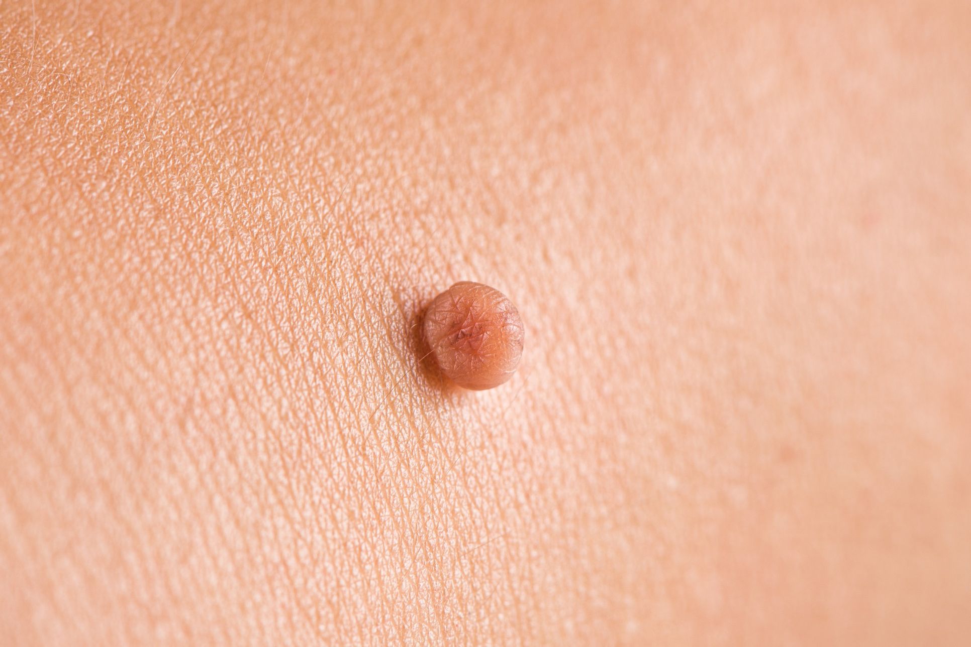Fibromy Malé kožní výrůstky a jejich typy Klinika komplexní péče